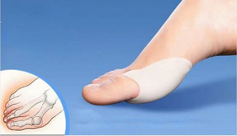 Фиксатор для косточек на ногах Вальгус Про (Valgus Pro)
